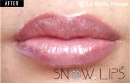 リップホワイトニングセッション後1